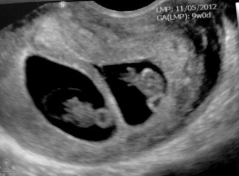 ultrasound-twins