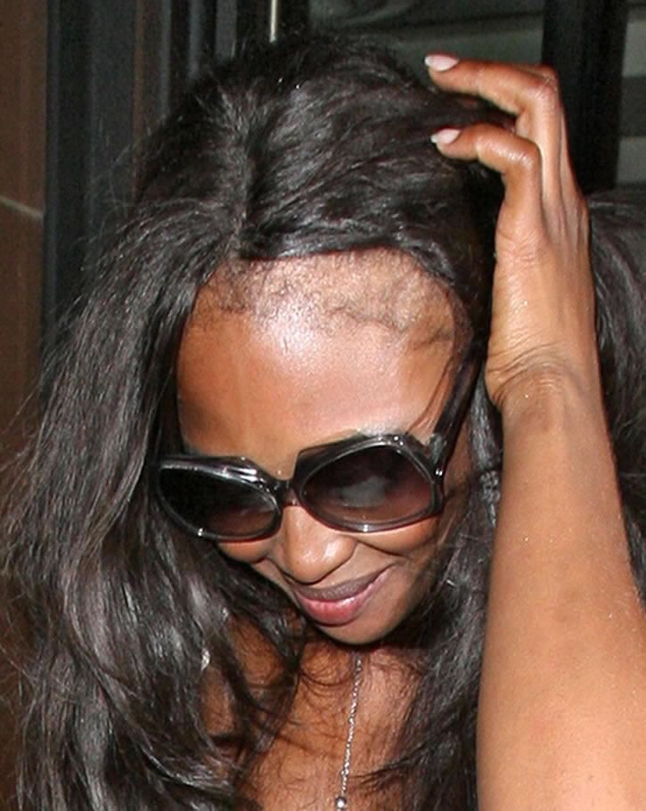 Traction Alopecia